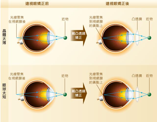 [视力康复]远近都看不清,远视比近视更痛苦